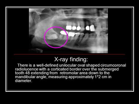 X-ray finding: There is a well-defined unilocular oval shaped circumcoronal radiolucence with a corticated border over the submerged tooth 48 extending.