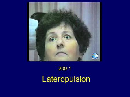 Lateropulsion 209-1. Lateropulsion (deviation) of the eyes towards the side of the lesion, under closed lids.