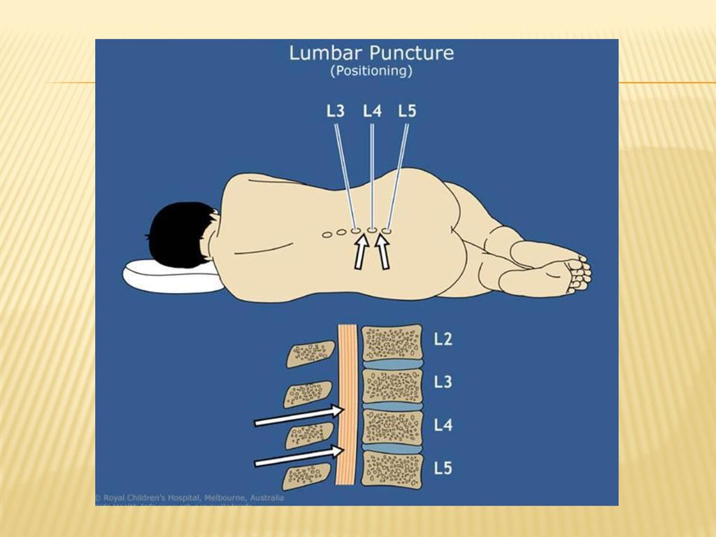 3 4 позвоночник. L3 l4 позвонки. Люмбальная пункция позвонки. L3-l4 позвоночник.