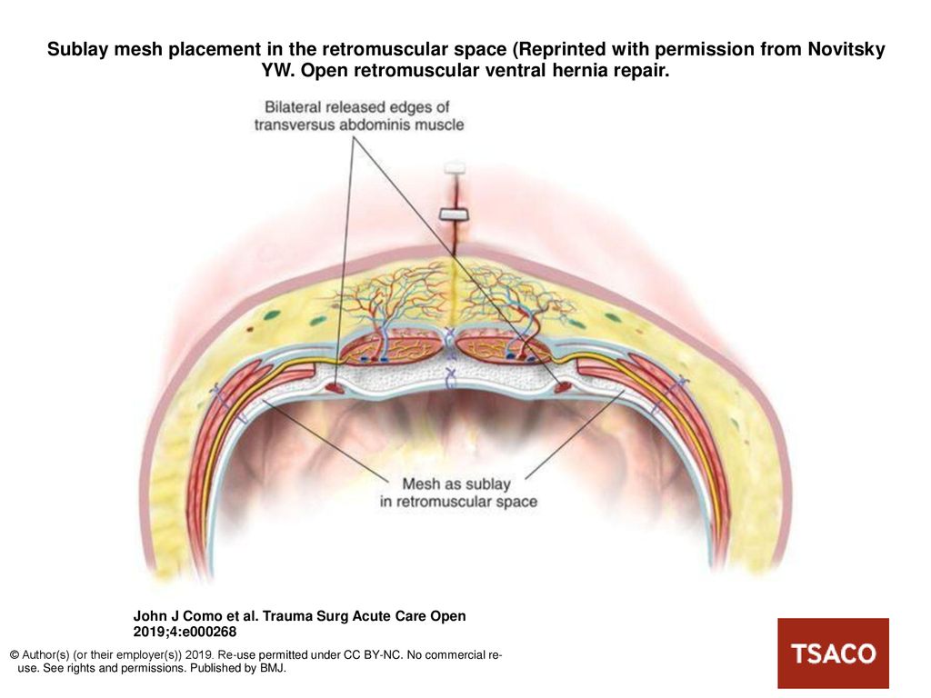 Sublay mesh placement in the retromuscular space (Reprinted with permission  from Novitsky YW. Open retromuscular ventral hernia repair. Sublay mesh  placement. - ppt download
