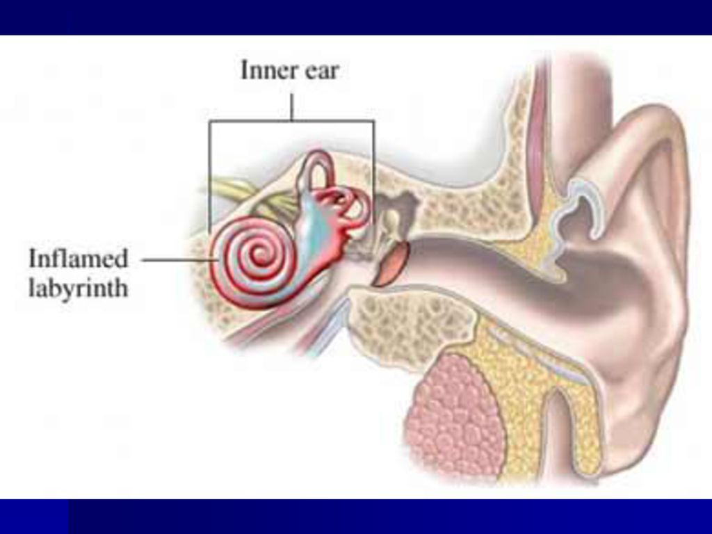 Полость внутреннего уха заполнена воздухом. Заболевания внутреннего уха. Что такое лабиринтит внутреннего уха. Воспалительные заболевания внутреннего уха (лабиринтиты)..