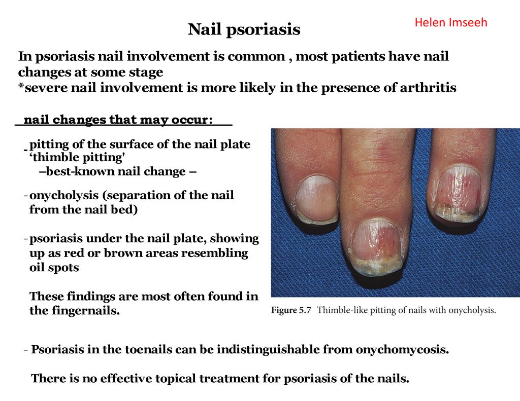 nail changes in psoriasis ppt