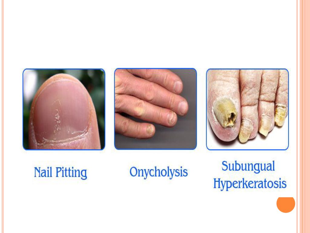 nail changes in psoriasis ppt)