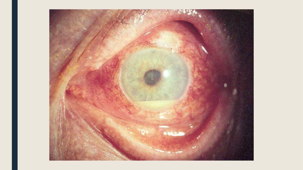 Uveitis Mohammad AbuAssi. - ppt download