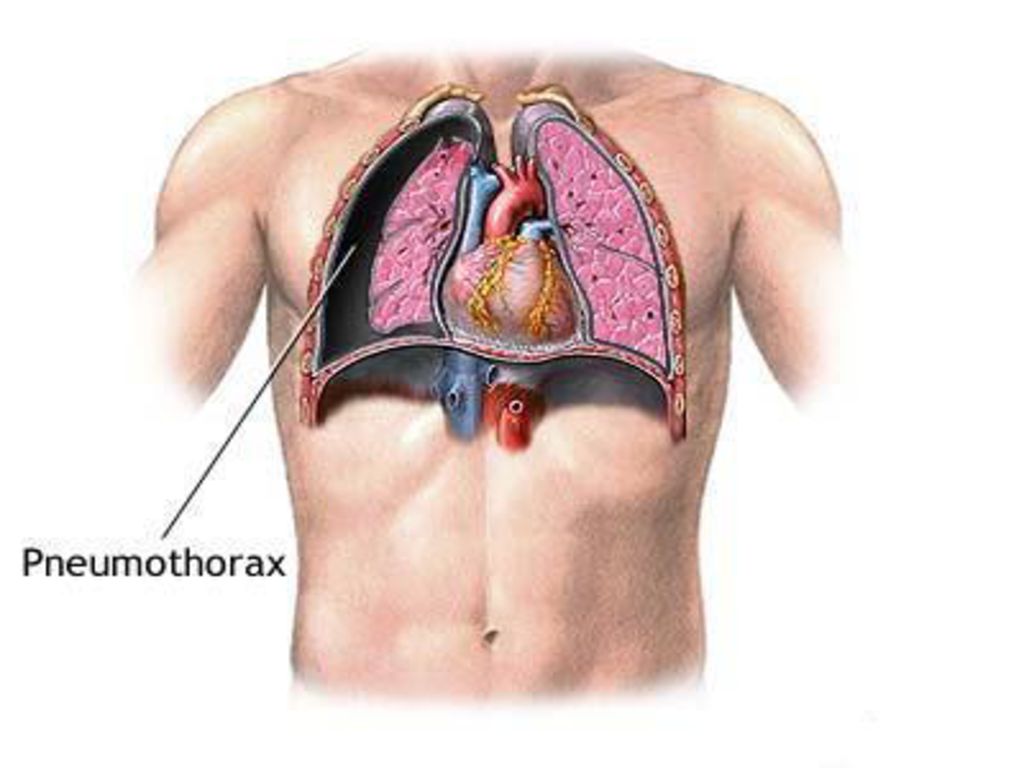 Плевропульмональные спайки в легких. Пневмоторакс пузырики. Пневмоторакс грудной клетки.