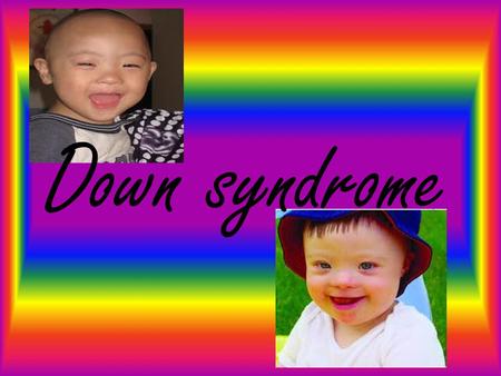 Down syndrome.