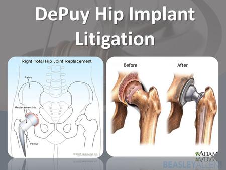 DePuy Hip Implant Litigation. DePuy Hip Implant Recall DePuy Orthopaedics is the subsidiary of Johnson & Johnson. 8/24/2010 – DePuy Orthopaedics voluntarily.