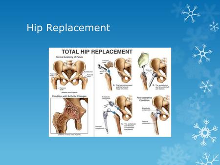 Hip Replacement. The Prevalence Of Hip Replacement  Hip replacement now is very common as opposed to before  Its most common factor comes from Osteoarthritis.