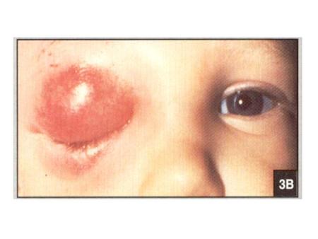 AAP Clinical Practice Guideline: Management of Sinusitis Pediatrics 108:798, 2001 (Sep)