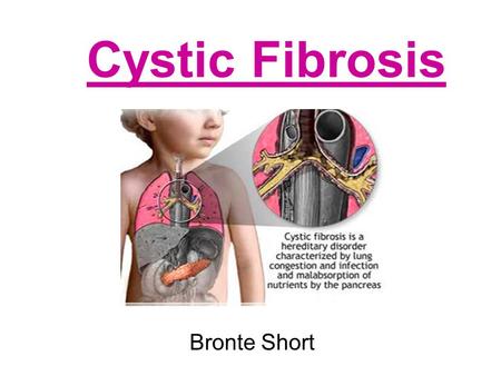 Cystic Fibrosis Bronte Short. What Cause Cystic Fibrosis? Cystic fibrosis, is an autosomal recessive hereditary disease that mostly affects the lungs,