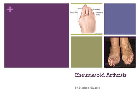 Rheumatoid Arthritis By, Marissa Miuccio.