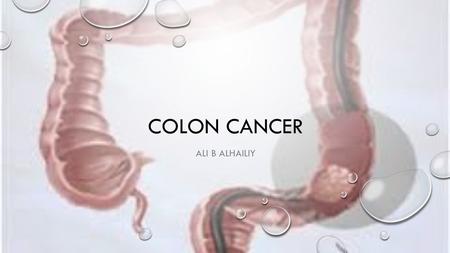 Colon cancer Ali b alhailiy.