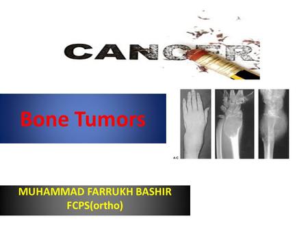 Bone Tumors MUHAMMAD FARRUKH BASHIR FCPS(ortho). General considerations Primary bone tumors are much less than secondary tumors. All age groups affected,