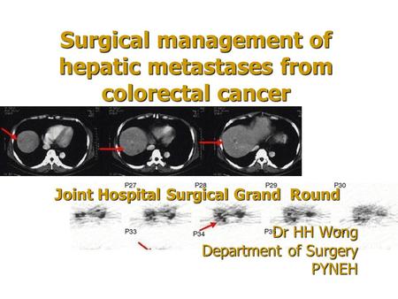 Surgical management of hepatic metastases from colorectal cancer Joint Hospital Surgical Grand Round Dr HH Wong Department of Surgery PYNEH.