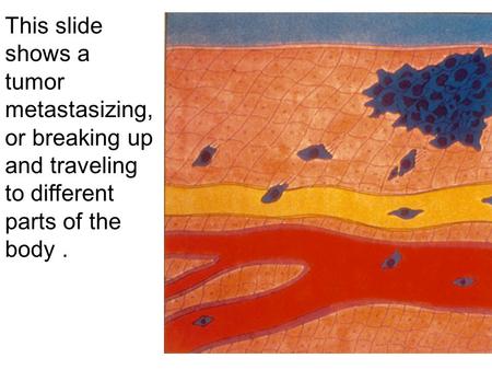 This slide shows a tumor metastasizing, or breaking up and traveling to different parts of the body.