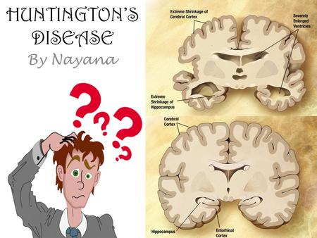 HUNTINGTON’S DISEASE By Nayana. WHAT IS HUNTINGTON’S DISEASE? Huntington’s disease slowly destroys your ability to think, talk, make decisions, etc.