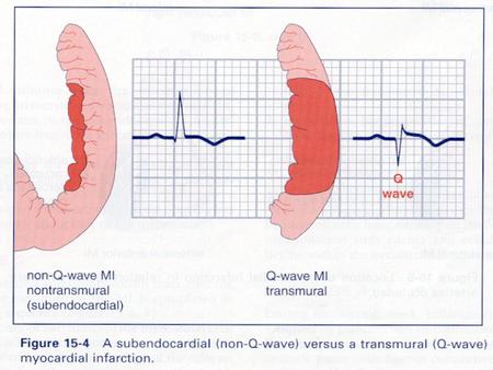 ECG Changes in Acute Myocardial Infarction Myocardial Ischemia Symmetrical T wave inversion or elevation and ST segment elevation or depression.