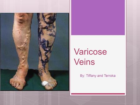 Varicose Veins By: Tiffany and Terroka. What happens?  Most varicose veins can sometimes lead to compilations, but are not serious medical problem. 