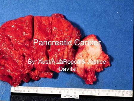 Pancreatic Cancer By: Austin LaRocca & Justice Davila.