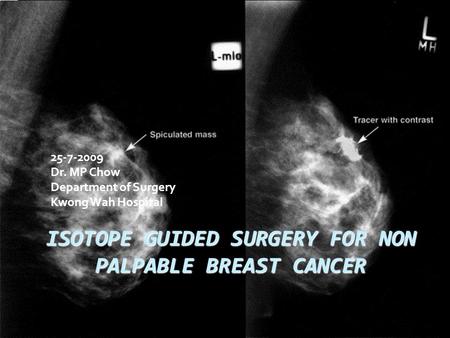 ISOTOPE GUIDED SURGERY FOR NON PALPABLE BREAST CANCER