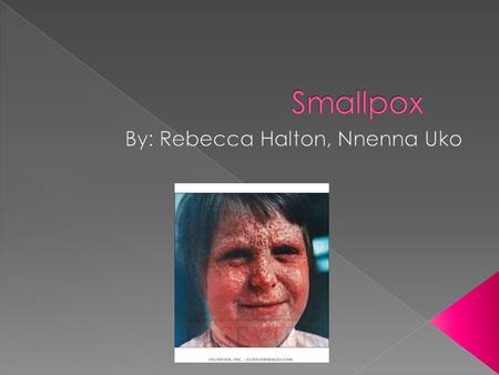  A serious infectious disease caused by the Orthopox Virus, Varoila.  Smallpox has been around for centuries.  Disease attacks the blood vessels within.