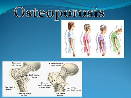 What is it? Osteoporosis is a disorder that is common of inflicting in a million Australians in which the bones start to become fragile and brittle leading.