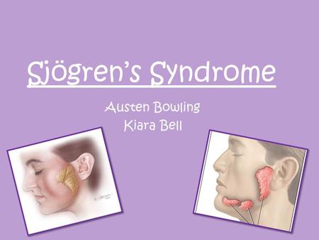 Sjögren’s Syndrome Austen Bowling Kiara Bell. What is Sjögren's Syndrome? a chronic disorder in which the white blood cells attack the saliva and tear.