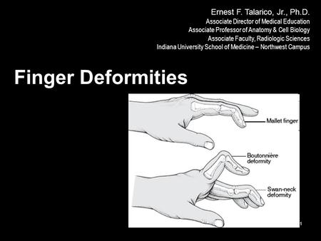 IUSM-NW F12 1 Finger Deformities Ernest F. Talarico, Jr., Ph.D. Associate Director of Medical Education Associate Professor of Anatomy & Cell Biology Associate.