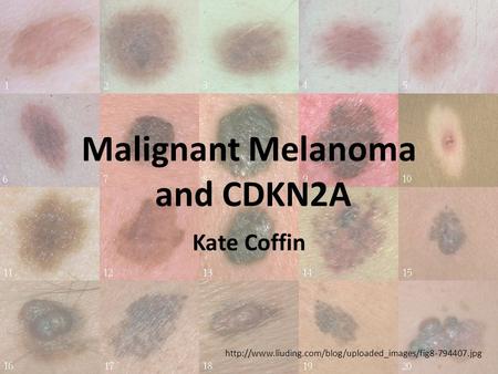 Malignant Melanoma and CDKN2A