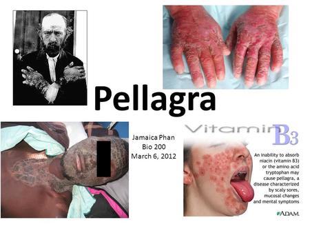 Pellagra Jamaica Phan Bio 200 March 6, 2012. What is it? -Pellagra is a systemic disease caused by vitamin B3 (niacin) deficiency. -Tryptophan can be.