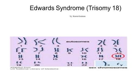 Edwards Syndrome (Trisomy 18) by: Karen Guzman. What is Edwards Syndrome? Edwards syndrome (Trisomy 18) is the most common autosomal abnormality among.
