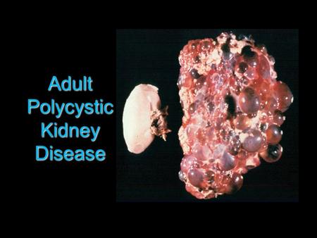 Adult Polycystic Kidney Disease.  Autosomal dominant  1-2 per 1000  Cysts present at birth, progressively enlarge to compress renal parenchyma  Occurs.