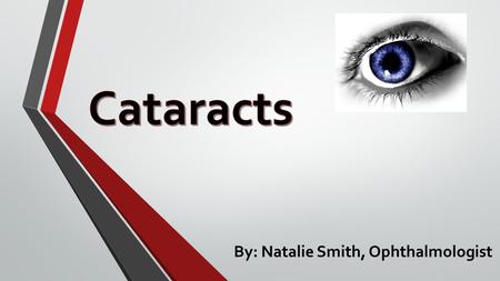 By: Natalie Smith, Ophthalmologist. What are cataracts? Cataracts are a clouding of the lens of the eye that can impair vision. There are 4 types of cataracts:
