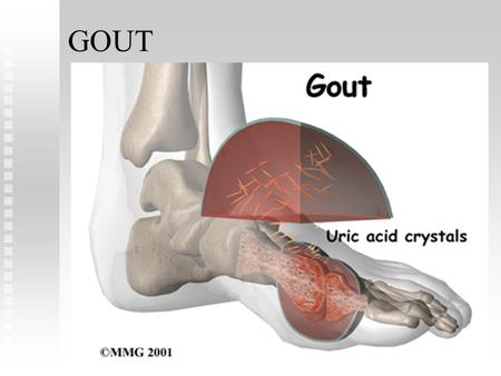 GOUT. Gout is a familial metabolic disease characterized by recurrent episodes of acute arthritis due to deposits of monosodium urate crystals. The metatarsophalangeal.