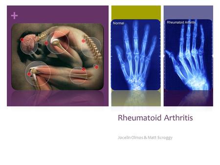 + Rheumatoid Arthritis Jocelin Olmos & Matt Scroggy.