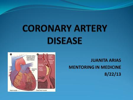 JUANITA ARIAS MENTORING IN MEDICINE 8/22/13. CORONARY ARTERY DISEASE Coronary Artery Disease takes place when the coronary arteries are hardened and narrowed.