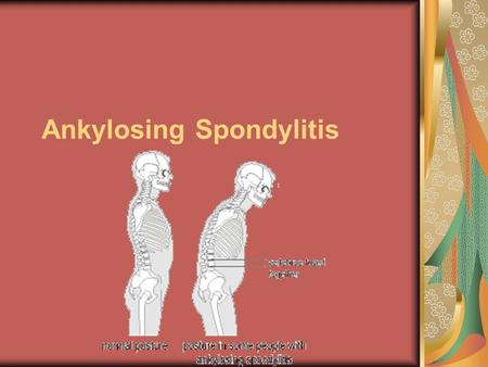 Ankylosing Spondylitis. ETIOLOGY/ PATHOPHYSIOLOGY Ankylosing spondylitis is a form of arthritis that is long-lasting (chronic) and most often affects.
