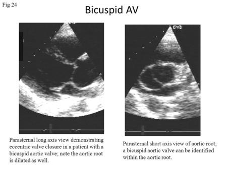 Bicuspid AV Parasternal long axis view demonstrating eccentric valve closure in a patient with a bicuspid aortic valve; note the aortic root is dilated.