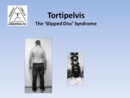 Tortipelvis The ‘Slipped Disc’ Syndrome
