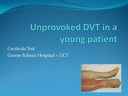Unprovoked DVT in a young patient