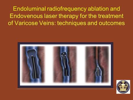 Endoluminal radiofrequency ablation and Endovenous laser therapy for the treatment of Varicose Veins: techniques and outcomes.