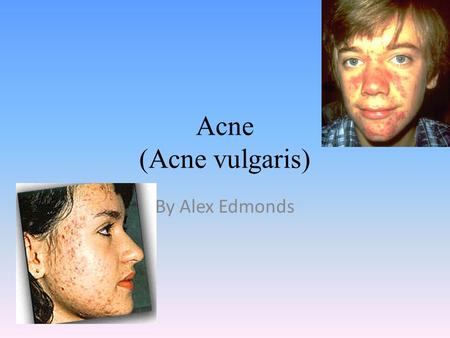 Acne (Acne vulgaris) By Alex Edmonds. What is the disease? Acne vulgaris is a disease that is when you get pimples on your body.
