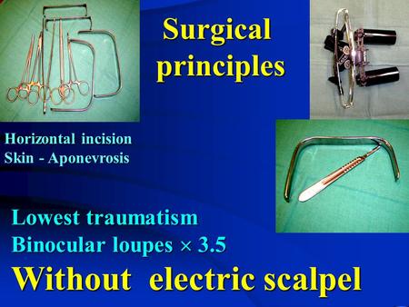 Lowest traumatism Binocular loupes  3.5 Without electric scalpel Surgicalprinciples Horizontal incision Skin - Aponevrosis.