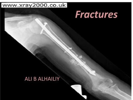 Fractures ALI B ALHAILIY.