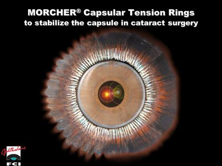 MORCHER® Capsular Tension Rings to stabilize the capsule in cataract surgery.