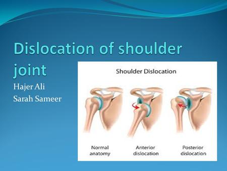 Hajer Ali Sarah Sameer. What is dislocation of the shoulder? What causes a shoulder dislocation? The shoulder joint is the most mobile joint in the body.