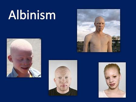 Albinism.