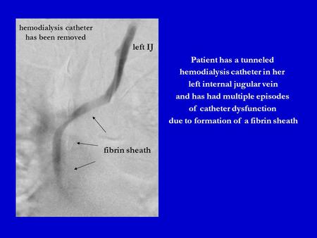 Patient has a tunneled hemodialysis catheter in her left internal jugular vein and has had multiple episodes of catheter dysfunction due to formation of.