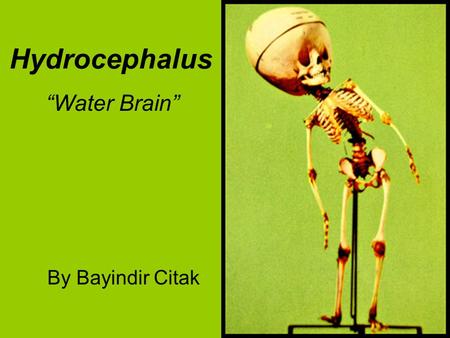 Hydrocephalus By Bayindir Citak “Water Brain”. Hydrocephalus Hydrocephalus is- The causes are- It affects someone by- The current treatment is- Works.