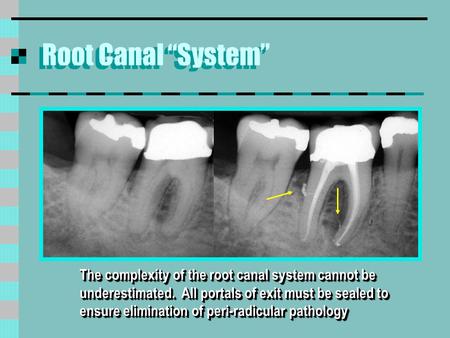 Root Canal “System” The complexity of the root canal system cannot be underestimated. All portals of exit must be sealed to ensure elimination of peri-radicular.